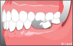 Pour remplacer les dents manquantes