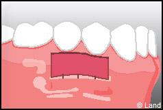 Chirurgie mucogingivale